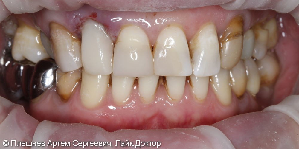 Восстановление 12 зуба - фото №4
