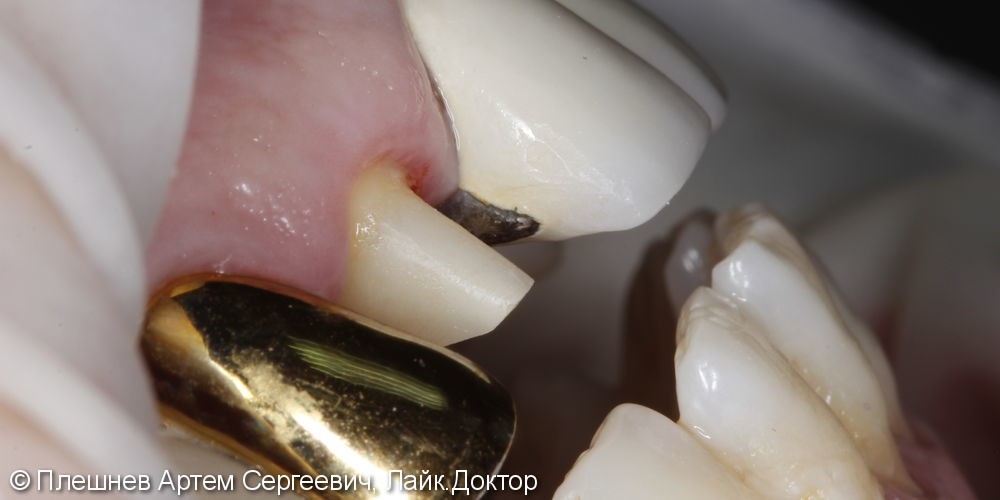 Восстановление 12 зуба коронкой - фото №3
