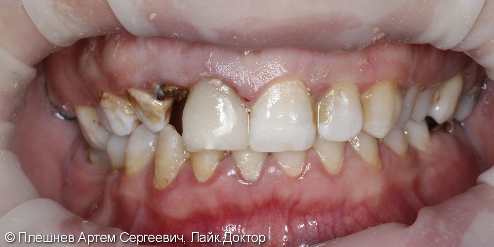 Восстановление 11 зуба - фото №2