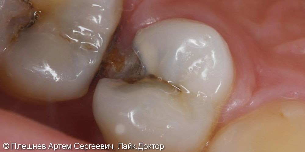 лечение глубокого кариеса 15 и 16 зуба - фото №1
