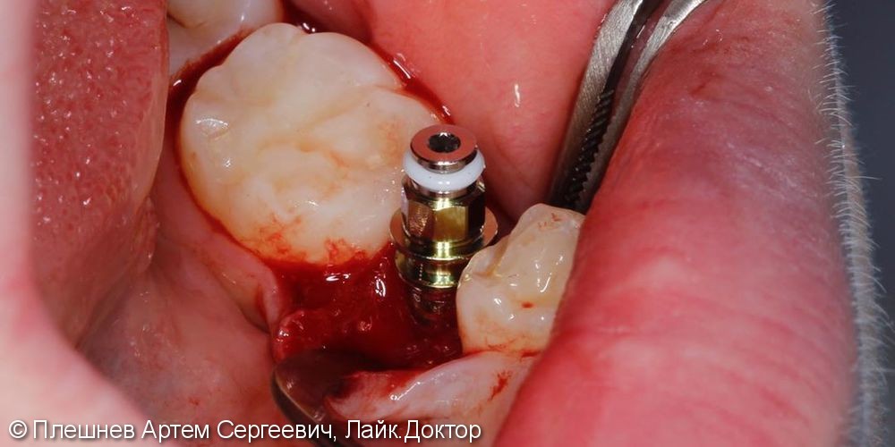 имплантация 35 зуба - фото №1