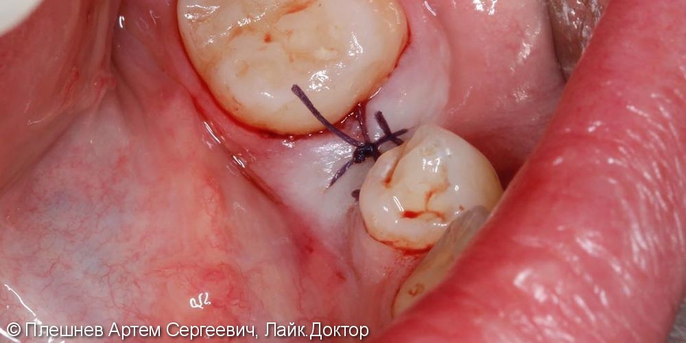имплантация 35 зуба - фото №3