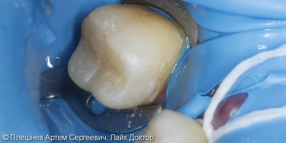 лечение кариеса 36 зуб - фото №2