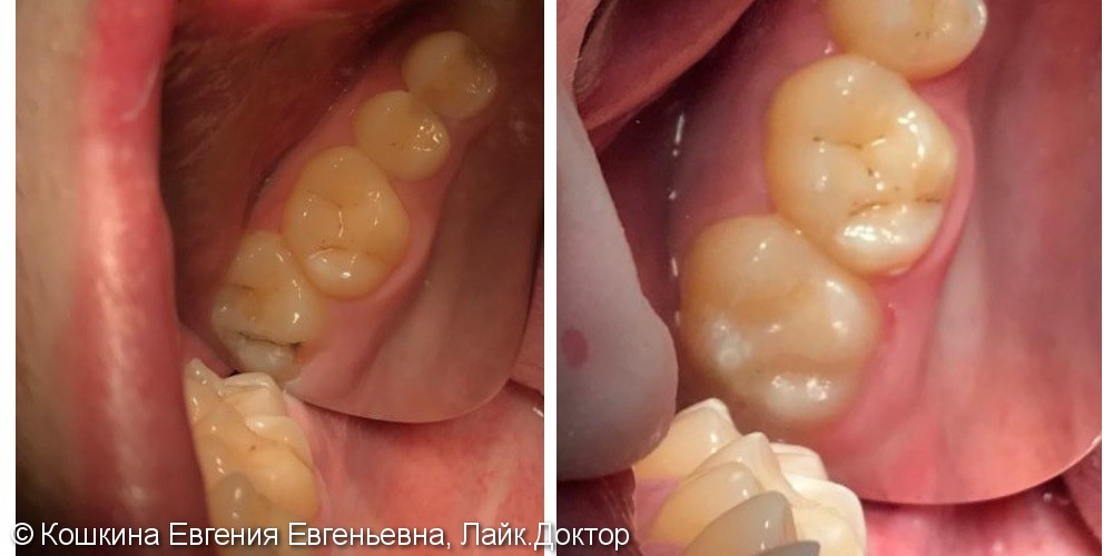 Лечение кариеса жевательного зуба, материал Gradia direct posterior - фото №1