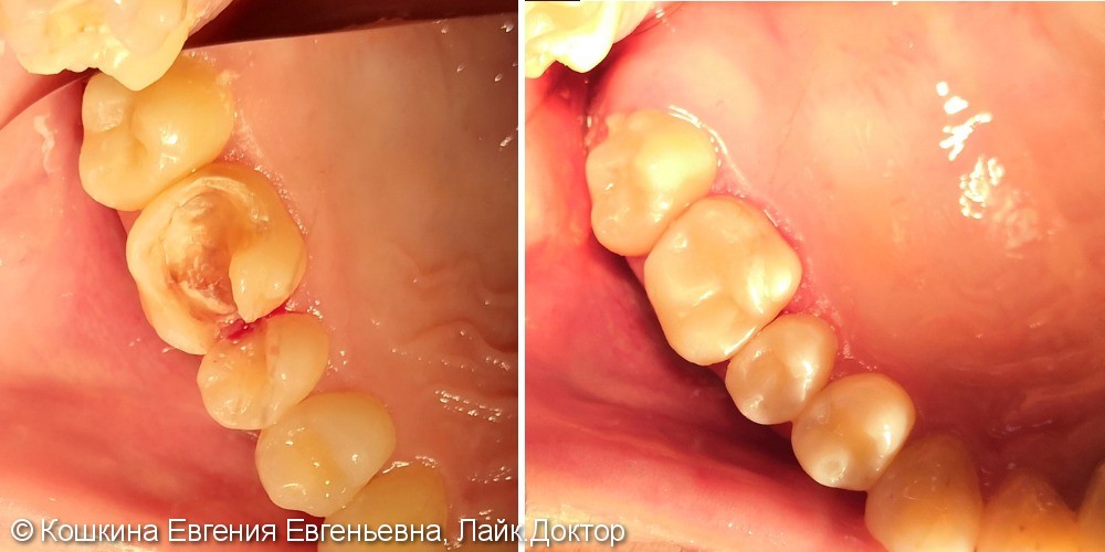 Кариес дентина апроксимальных поверхностей зубов 15 и 16 - фото №1