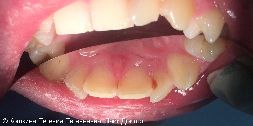 Кариес дентина зуба 22 - фото №1