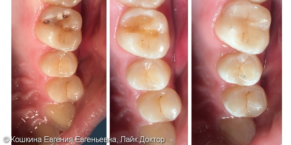 Лечение кариеса дентина зуба 26. - фото №1