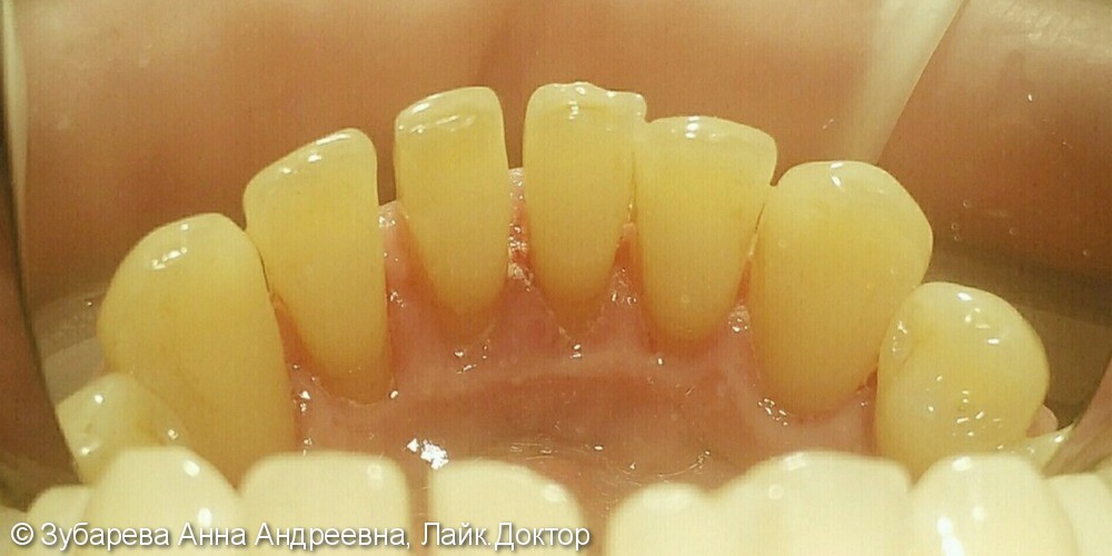Закрытый кюретаж пародонтальных карманов в области зубов верхней и нижней челюсти - фото №4