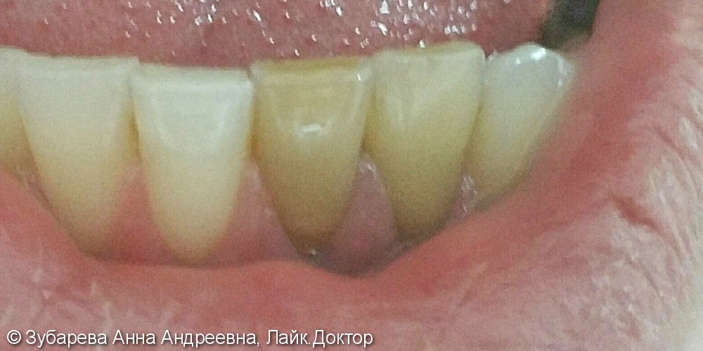 Внутрикоронковое отбеливание зубов - фото №1