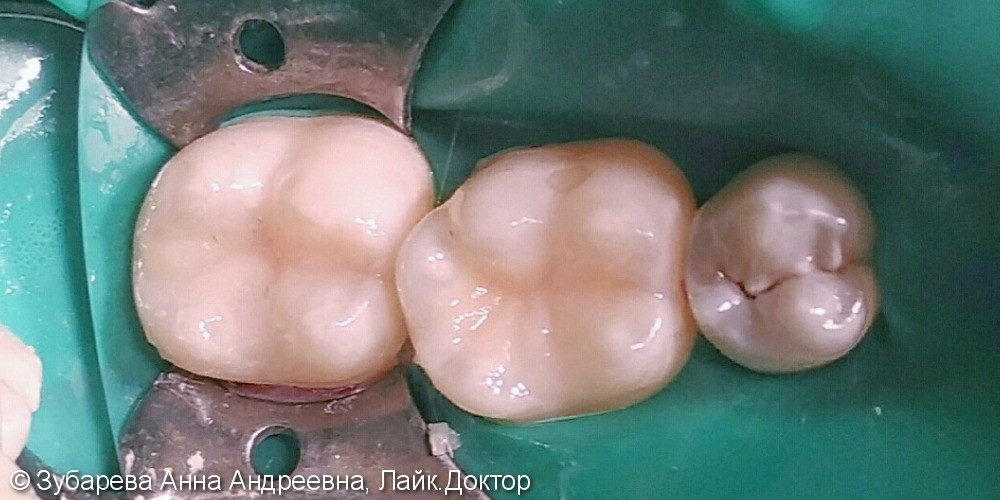 Замена пломб на жевательных зубах - фото №2