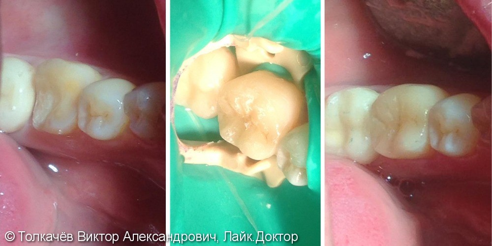 Реставрация зуба с применением вкладки E-MAX - фото №1