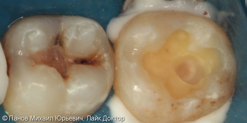 Лечение кариеса жевательных зубов на нижней челюсти - фото №2