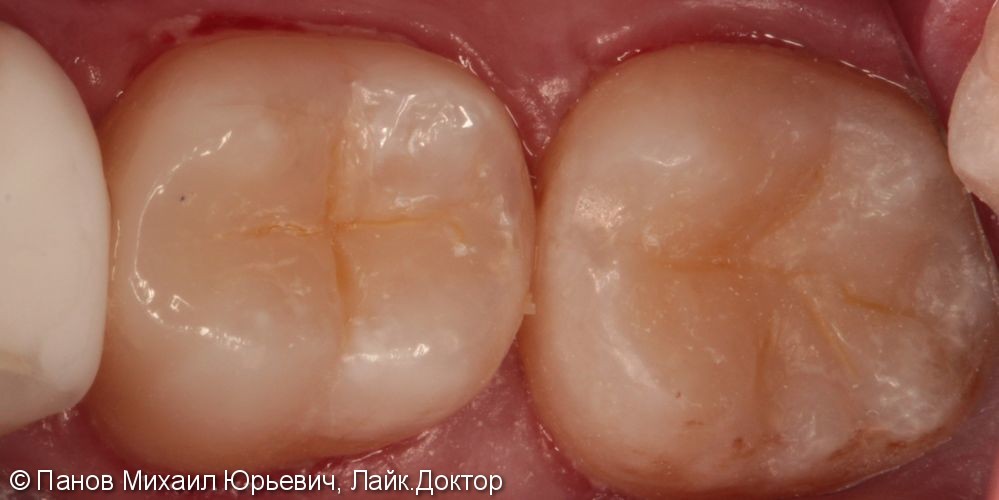 Лечение кариеса жевательных зубов на нижней челюсти - фото №4