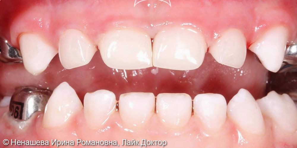 Восстановление молочных зубов - фото №2