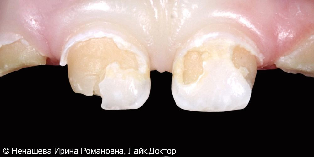 Восстановление пломбами молочных зубов - фото №1