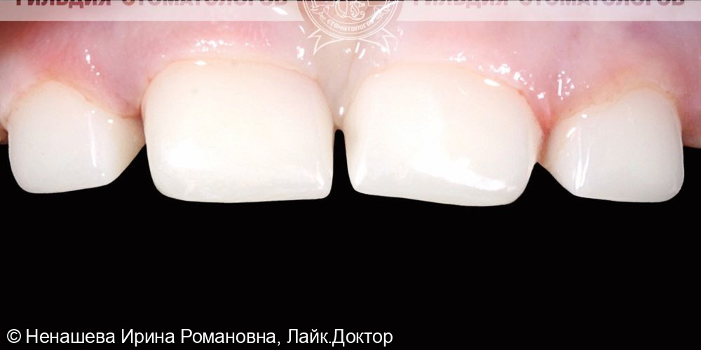 Восстановление пломбами молочных зубов - фото №2
