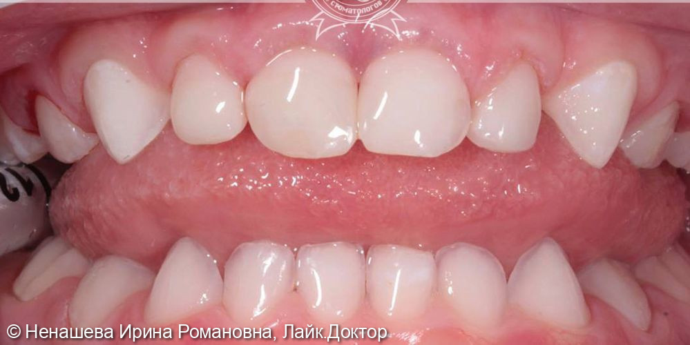 Лечение зубов под наркозом - фото №2