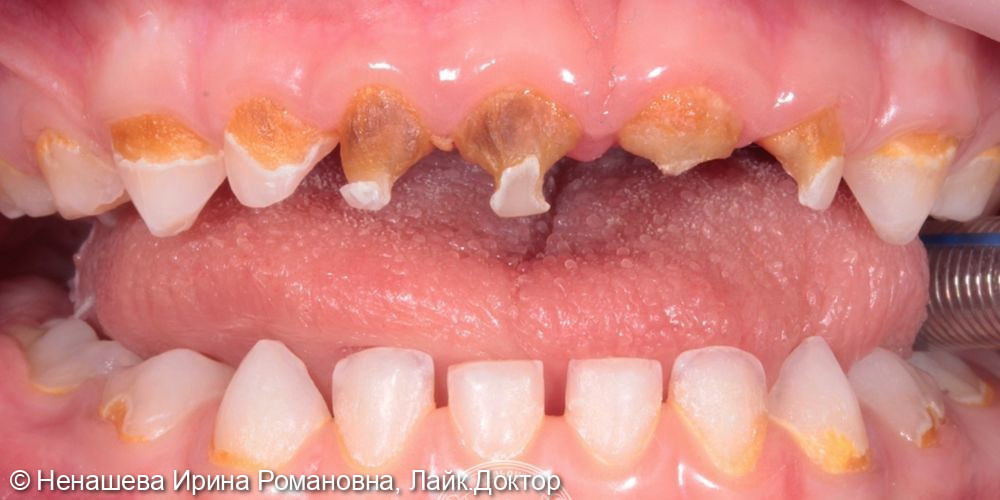 Маленькому пациенту всего 4 года, но при этом уже 7 кариесов, 5 пульпитов и даже периодонтит на одном зубе - фото №1