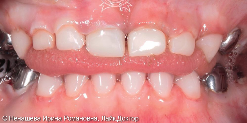 Маленькому пациенту всего 4 года, но при этом уже 7 кариесов, 5 пульпитов и даже периодонтит на одном зубе - фото №2