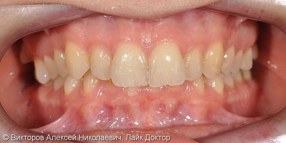 Ортодонтическое лечение на брекетах, результат до и после - фото №1
