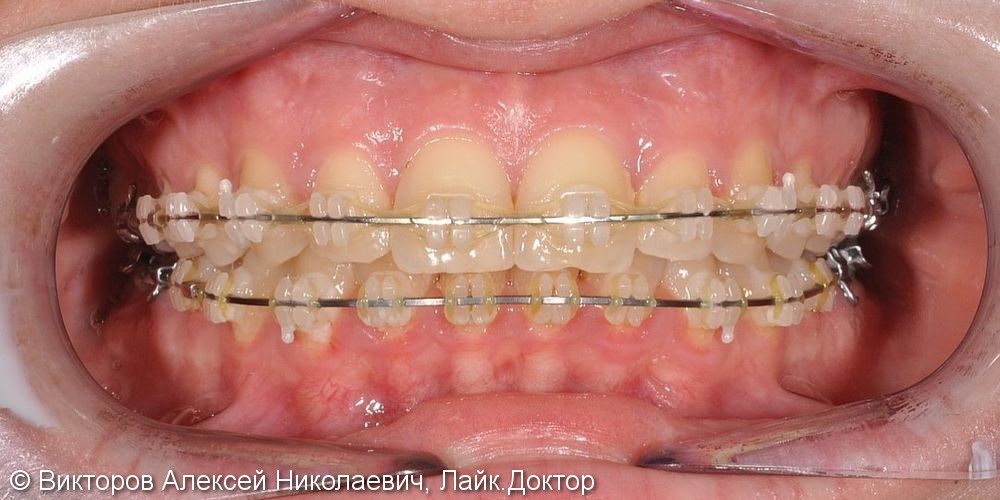Ортодонтическое лечение на брекетах, результат до и после - фото №2