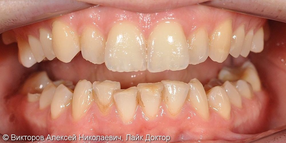 Ортодонтическое лечение на брекетах, результат до и после - фото №3