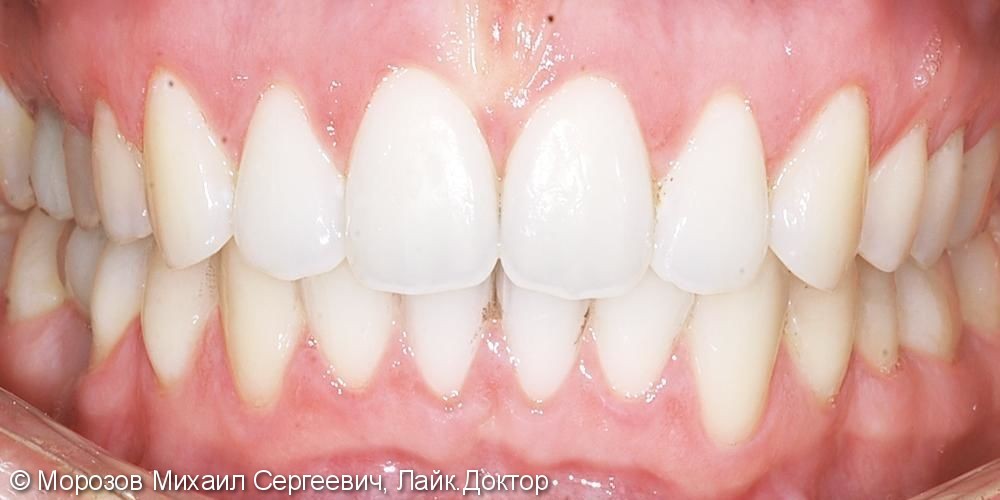 Лечение дистального прикуса, сужения зубных рядов, исправление эстетики улыбки - фото №2