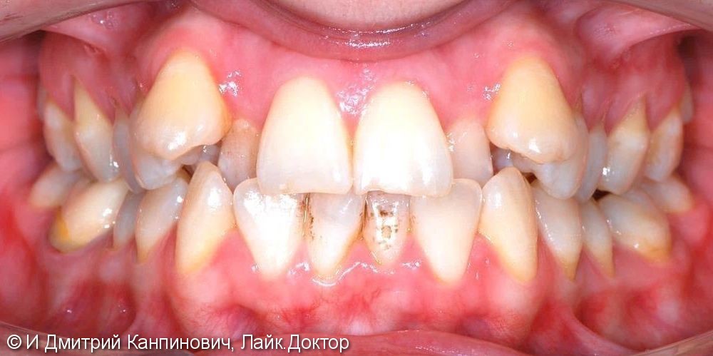 Лечение дистального прикуса, скученности зубных рядов - фото №1