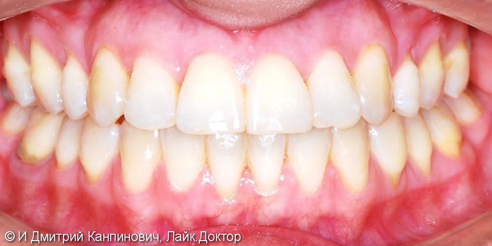 Лечение дистального прикуса, скученности зубных рядов - фото №2