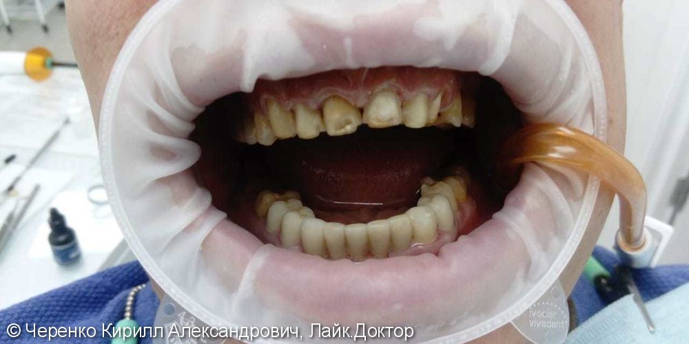 Виниры цвет Bl2, исправление эстетики зубов - фото №1