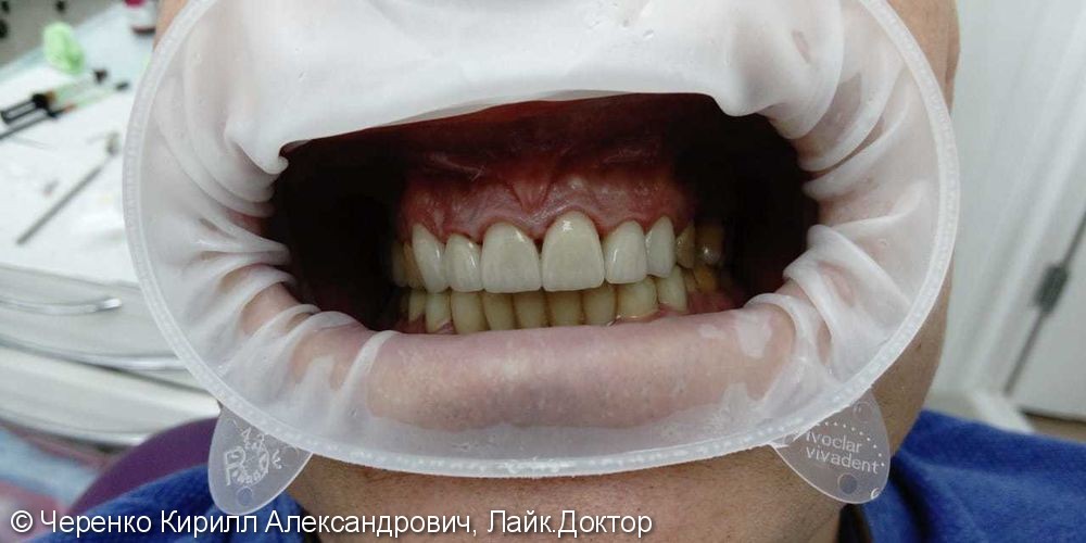 Виниры цвет Bl2, исправление эстетики зубов - фото №2