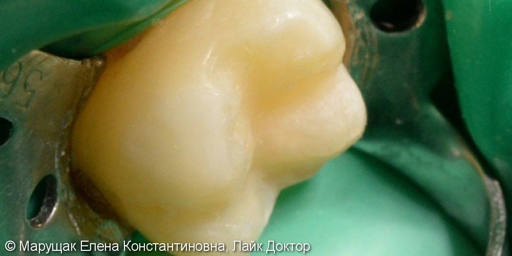 Лечение кариеса и художественная реставрация зуба, до и после - фото №2