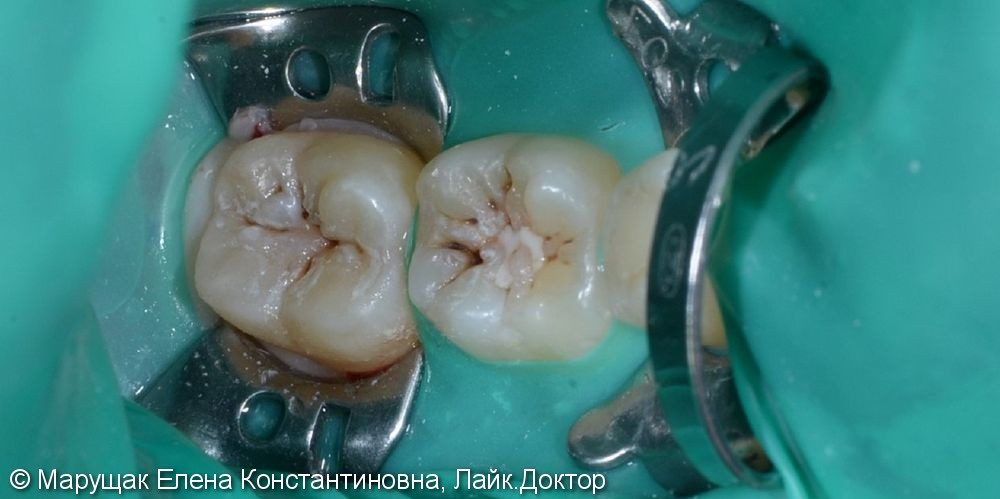 Лечение фиссурного кариеса двух зубов за одно посещение - фото №1