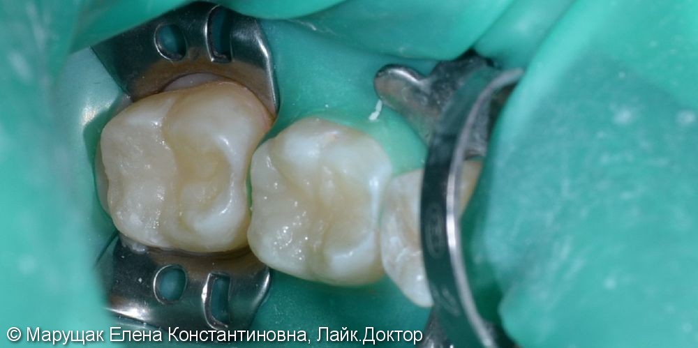 Лечение фиссурного кариеса двух зубов за одно посещение - фото №3