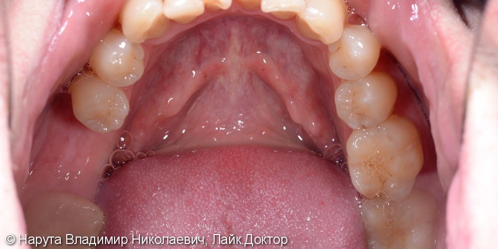 Замещение утраченного зуба имплантом Nobel Parallel - фото №1