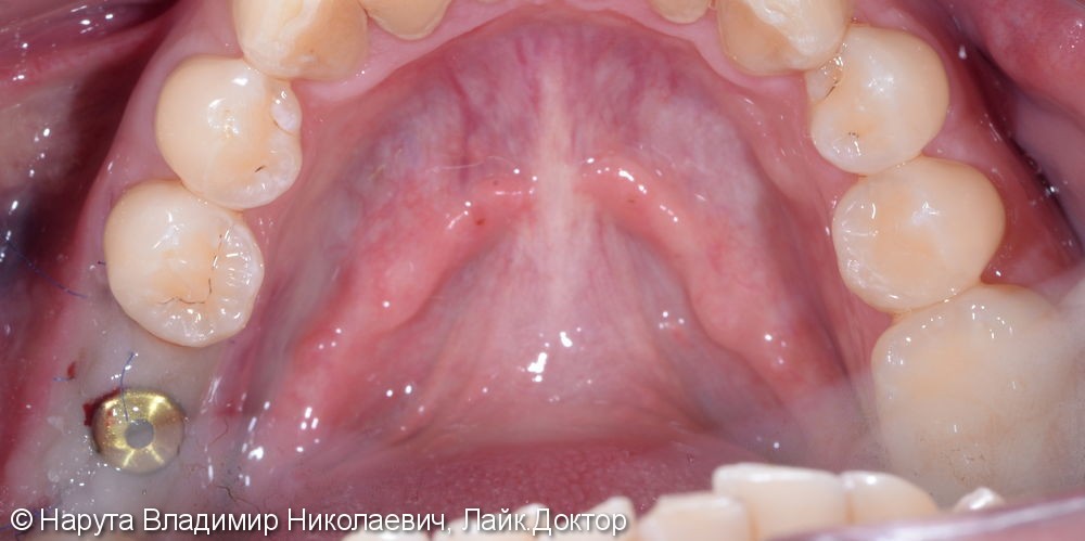 Замещение утраченного зуба имплантом Nobel Parallel - фото №2