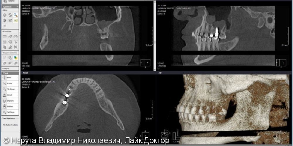 Восстановление жевательного зуба с помощью импланта Nobel Parallel - фото №1