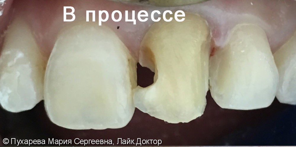 Реставрация переднего зуба 2.1 виниром из светокомпозита - фото №2