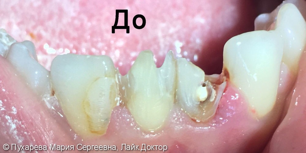Лечение кариеса двух центральных резцов нижней челюсти - фото №1