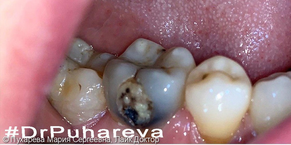 Лечение и реставрация зуба 4.6 - фото №1