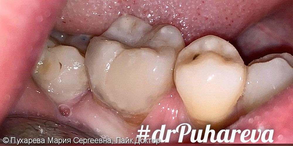 Лечение и реставрация зуба 4.6 - фото №2