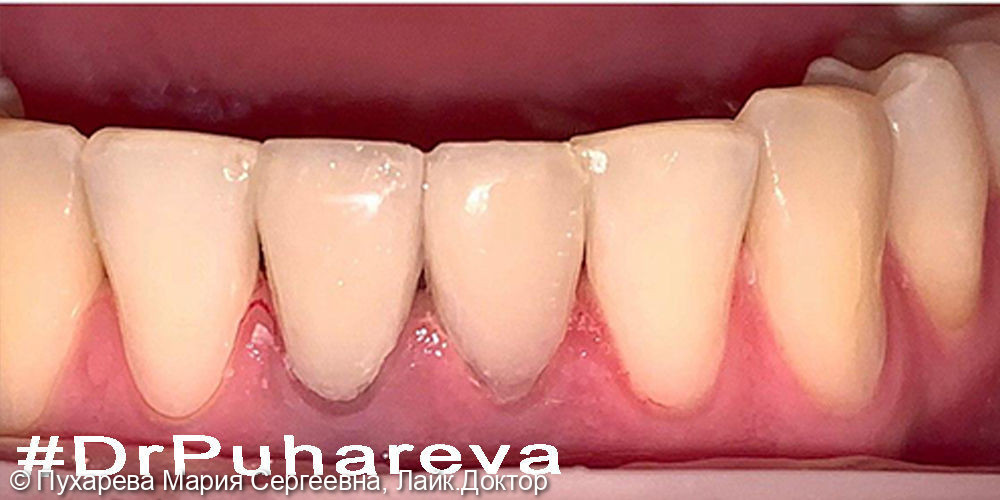 Реставрация зубов композитными винирами - фото №2