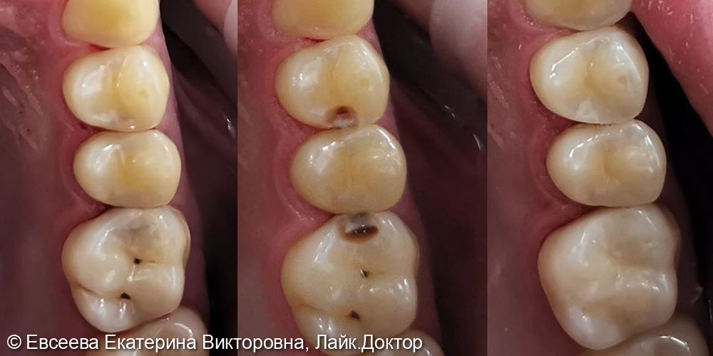 Лечение кариеса 2.4 и 2.6 зубов - фото №1
