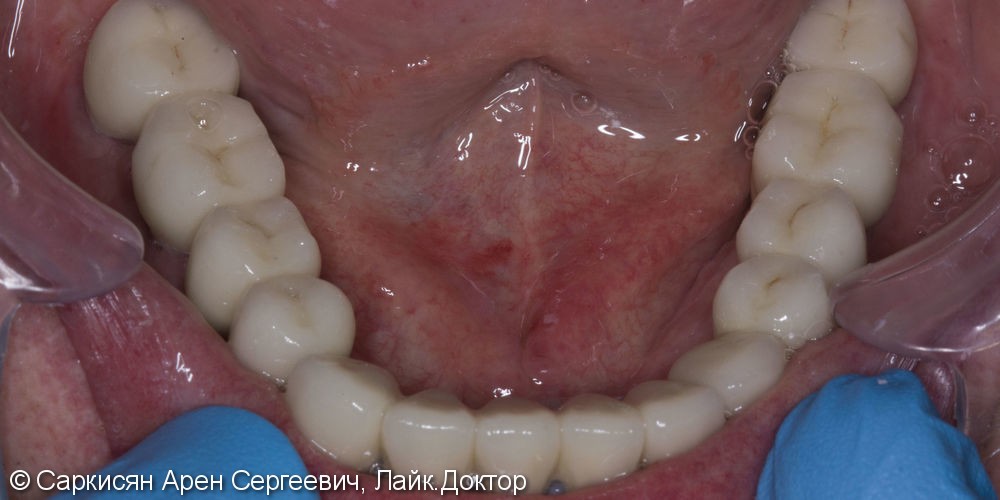 Восстановление зубов нижней челюсти на 7 имплантах и м/к коронках - фото №2