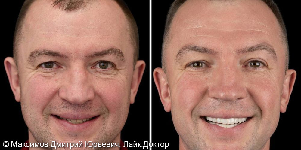 Восстановление зубов - фото №1