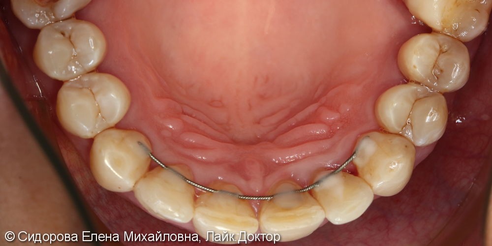 Шинирование передних зубов при хроническом генерализованном пародонтите. - фото №7
