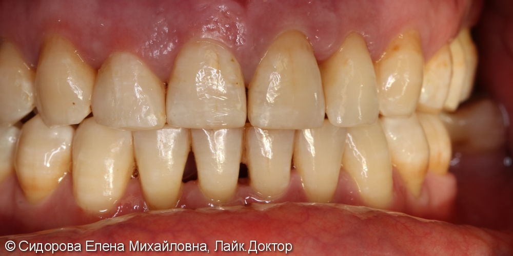 Шинирование передних зубов при хроническом генерализованном пародонтите. - фото №2