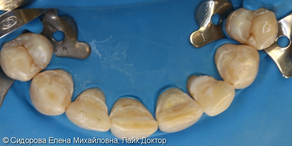 Шинирование передних зубов при хроническом генерализованном пародонтите. - фото №3