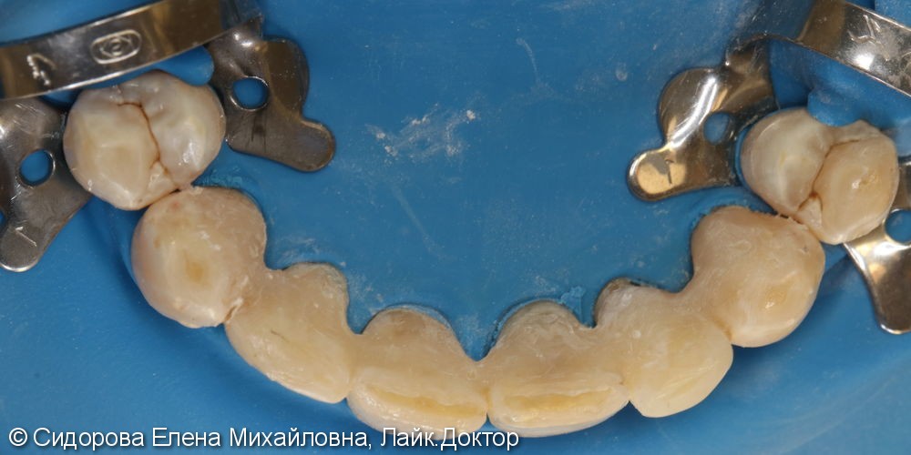 Шинирование передних зубов при хроническом генерализованном пародонтите. - фото №4