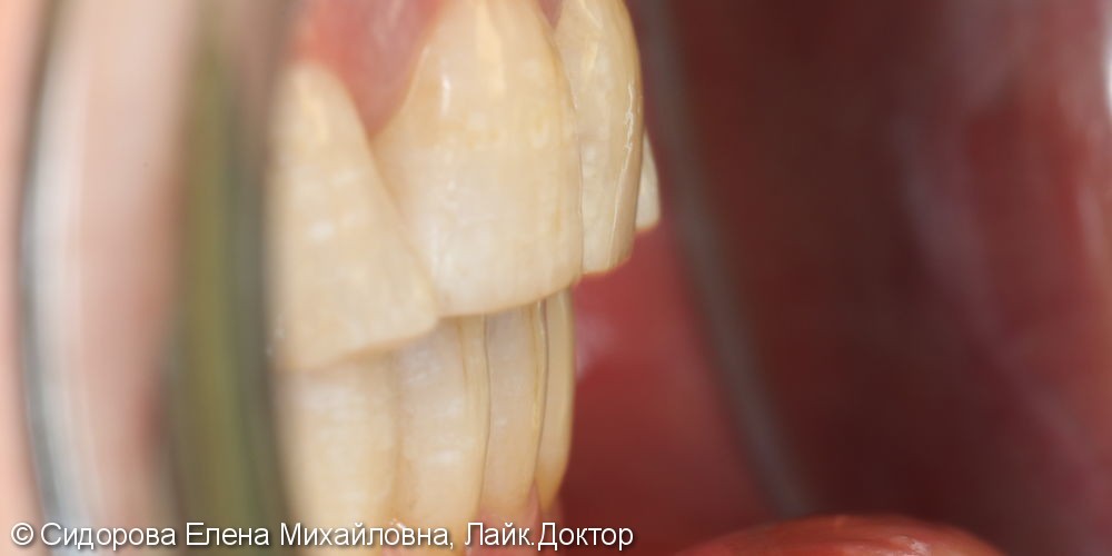 Шинирование передних зубов при хроническом генерализованном пародонтите. - фото №6